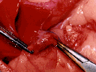 Clamps on either side of tumor - Click to Enlarge