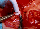 Tumor being frozen with liquid nitrogen - Click to Enlarge